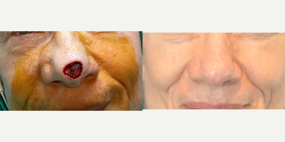 55-64 year old woman treated with Mohs Surgery - Adjacent Tissue Transfer on Nasal Tip.