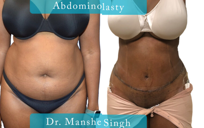 Woman treated with Tummy Tuck - Woman treated with Tummy Tuck