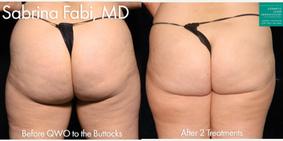 35-44 year old woman treated with Qwo - Qwo use to to treat cellulite on the buttocks of a female patient by Dr. Fabi.