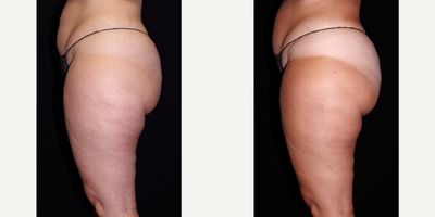 45-54 year old woman treated with Cellulaze - 45 year old female received Cellulaze to the outer thighs; photos depict the patient's results 11 weeks post-op.
