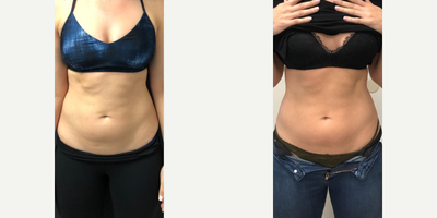 Woman treated with truSculpt iD - Woman treated with truSculpt iD.