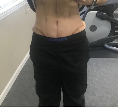 3 Months Post Panniculectomy Andrew M Lofman Md Facs Review