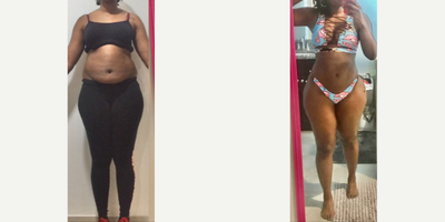 25-34 year old woman treated with BodyTite, Liposuction - 25-34 year old woman treated with BodyTite, Liposuction