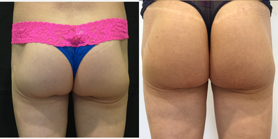 Non Surgical Brazilian Butt Lift using Sculptra Aesthetic - 45-54 year old woman treated with Sculptra Aesthetic for Non Surgical Brazilian Butt Lift. Post 3 Treatments spaced month apart. The ideal candidate is under 150 # and within 15% of their ideal BMI.