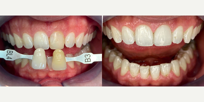 18-24 year old man treated with Internal Tooth Bleaching - We applied internal tooth bleaching to the discolored tooth of our patient in 3 days and applied veneer with porcelain filling in 45 minutes.