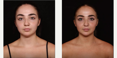 18-24 year old woman treated with Buccal Fat Removal - 18-24 year old woman treated with Buccal Fat Removal