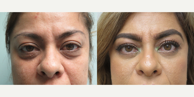 45-54 year old woman treated with Eyelid Surgery - This patient had rejuvenation to her lower eyelids by a lower lid Blepharoplasty with Canthopexy