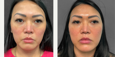35-44 year old woman treated with Kybella - This woman in her early forties desired Kybella, a nonsurgical injectable treatment that improves the appearance of below-the-chin fat. Her provider, Heather administered one 4CC round of Kybella and applied ice afterwards to help with swelling. She looks great and is pictured before and five weeks afterwards.