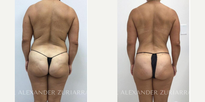 45-54 year old woman treated with Mommy Makeover, Breast Augmentation, Breast Implants - 45-54 year old woman treated with Mommy Makeover, Breast Augmentation, Breast Implants- 4 months post-op