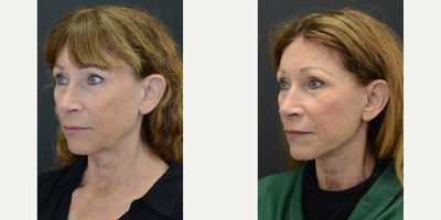 65-74 year old woman treated with CO2 Laser, Facelift, Lifestyle Lift, Lower Facelift, Neck Lift, SMAS Facelift - Patient had a lower face and neck lift with a CO2 laser.