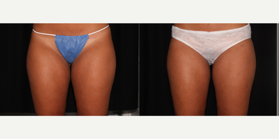 25-34 year old woman treated with EndyMed 3Deep - Received two treatments of Endymed 3Deep radio frequency on her inner thighs to remove stubborn fat that caused rubbing. Amazing results!