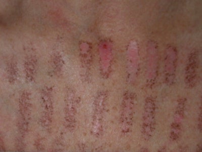 IPL Laser Hypopigmentation ~ How Do I Treat It?