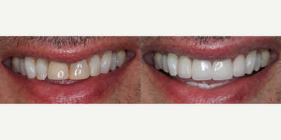 Man treated with Dental Implants - Man treated with Dental Implants (one) as well as one crown, two veneers (total of 4 teeth) and teeth whitening.