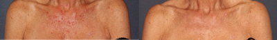 55-64 year old woman treated with Photodynamic Therapy - Dr. Fabi treated this 60 year old woman with PDT to treat age and sun spots.