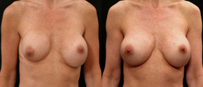 Breast Implant Revision - 
	Breast Implant Revision
