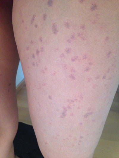 Are these spots from laser permanent? If not, how many 