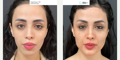 25-34 year old woman treated with Chin Implant, Jaw Implants - Chin & Jaw Implant Surgery