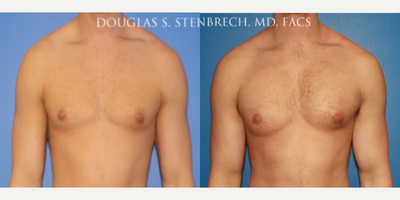 Man treated with Bicep Implants - Man treated with Bicep and Pectoral Implants