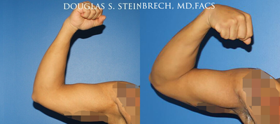 Man treated with Bicep Implants - Man treated with Bicep Implants