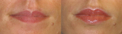 Juvederm Lip Augmentation - 
	Early 30's woman s/p Juvederm for lip augmentation
