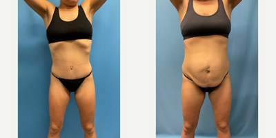 25-34 year old woman treated with Tummy Tuck - This 32 year old female underwent a Full Tummy Tuck with liposuction of the flanks.