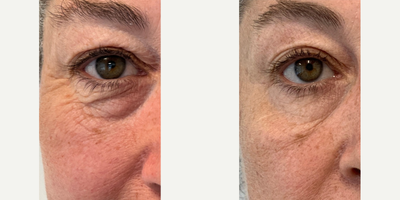 Woman treated with Microneedling RF - Say goodbye to tired, crepey under eyes with virtue Rf! We love these incredible results just two months after only one Exact RF treatment!The Exactb RF handpiece targets the delicate under-eyes with a single needle. It delivers radiofrequency heat energy to stimulate your body's natural collagen production to tighten the skin, decrease puffiness, and more.