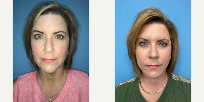 45-54 year old woman treated with Facelift, Neck Lift, Liposuction - Patient had a Facelift and Neck lift with suction assisted Lipo