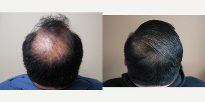 35-44 year old man treated with NeoGraft - This gentleman was unhappy with his male pattern baldness and decided to undergo Neograft FUE hair transplantation. 3100 FUE were extracted from the occipital scalp donor site and transferred to the frontal scalp as well as crown.