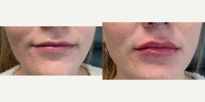 18-24 year old woman treated with Dermal Fillers - The doctor added volume and enhanced the shape of this 24-year-old patients lips with Restylane Kysse.