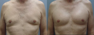 53 Year Old Male Treated for Chest Sagging - Dr Shifrin met this 53 year old male in consultation to discuss a Pectoral Augmentation. He specifically wanted to improve the volume loss and sagging of his chest that developed with age. Dr Shifrin performed a chest augmentation with silicone pectoral implants through a hidden scar armpit approach. Results at 4 months.