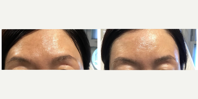 35-44 year old woman treated with 1540 and IPL for Mild Melasma - Be very careful with laser for melasma, but you can get some nice improvement.