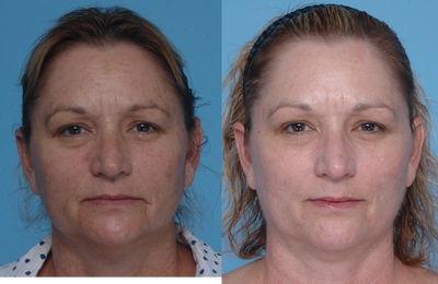 Active FX - 
	Patient age: 49 years
