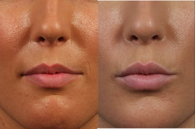 25-34 year old woman treated with Lip Augmentation - 25-34 year old woman treated with Lip Augmentation