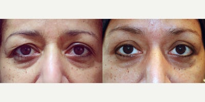 35-44 year old woman treated with Eyelid Retraction Repair - Upper Blepharoplasty Surgery to 37 year old female to improve tired, puffy eyelids.