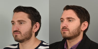25-34 year old man treated with Rhinoplasty - 25 year old male wanting to smooth out dorsal hump and lift his drooping nasal tip.