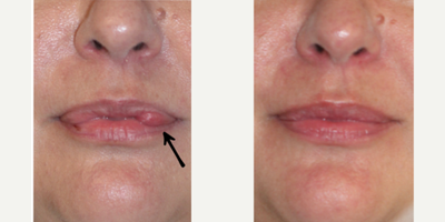 45-54 year old woman treated with Lip Reduction - Another pair of lips saved by Dr. Z!Silicone strikes again! Unfortunately, this former Spanish model was pressured to have silicone placed in her lips. Here she is shown 6 months post lip reduction and silicone removal. She's so pleased with her results that she just bought the first tube of lipstick that she's bought in years!!IMPORTANT TIPS TO AVOID THIS HAPPENING TO YOU:*Remember, if a deal seems too good to be true, it probably is.*Make sure you always go to a reputable, experienced provider for injections in a professional, medical setting.*Always make sure your provider takes your product out of its original package before injecting!!