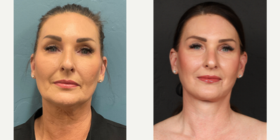 45-54 year old woman treated with Facelift, Lower Facelift, SMAS Facelift - This 54 year old patient came in for a lower facelift to tighten her neck, jowls and jawline.