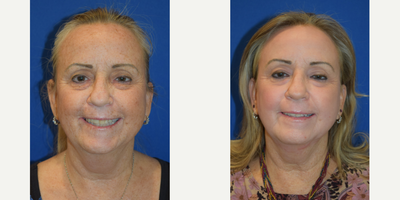 55-64 year old woman treated with Renuvion - 61 year old female who underwent a Full Face Renuvion Skin Resurfacing procedure