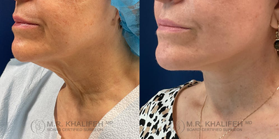 45-54 year old woman treated with Neck Lift - A neck lift can be performed with a limited incision that starts at the ear lobe and goes behind the ear and into the occipital area. These incisions will allow for muscle tightening and skin removal to rejuvenate the neck region.