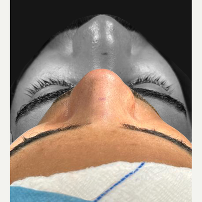 25-34 year old man treated with African American Rhinoplasty - Our patient wanted to have a smaller nose with natural change.We combined reduction-augmentation rhinoplasty with rib cartilage in this case.And this is before and immediate after.