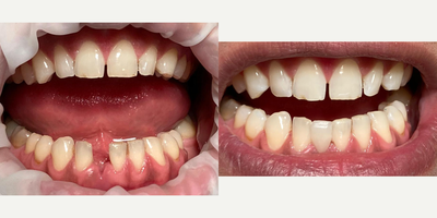 35-44 year old man treated with Tooth Repair - We strengthened the tooth root of our patient with a fiber post and placed a ceramic filling on it. The process took 1.5 hours.