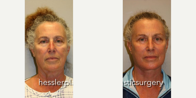 Woman treated with Deep Plane Facelift - Woman treated with Deep Plane Facelift with necklift, blepharoplasty, browlift and laser resurfacing to the skin.