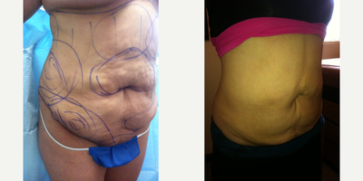 35-44 year old woman treated with Smart Lipo - Smart liposuction of abdomen and flanks