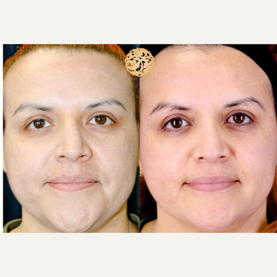 35-44 year old woman treated with Facial - The Dermalinfusion Silkpeel exfoliates, extracts and infuses.