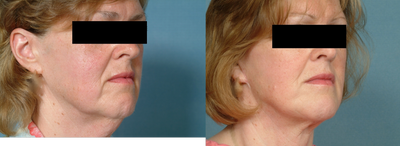 Age: 51, Height: 55, Weight: 178lbs. - 
	Necklift.
