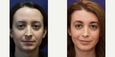 Transgender woman treated with Chin Implant - Chin Implant FFS