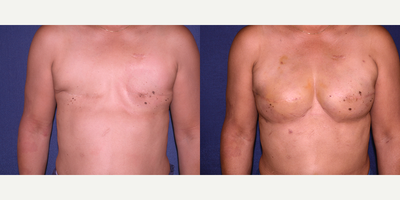 Woman treated with Breast Fat Transfer - Woman treated with Breast Fat Transfer
