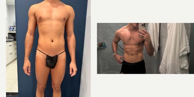 Male HD Lipo: Torso & Chest Contouring - High-definition Gladiator Lipo with Renuvion skin tightening of the torso and chest. Fat grafting to the buttocks, a nipple lift, gland removal, and pec implants were performed to create a sculpted, masculine chest and overall stronger physique.
