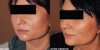 Woman treated with Facelift - Woman treated with Facelift