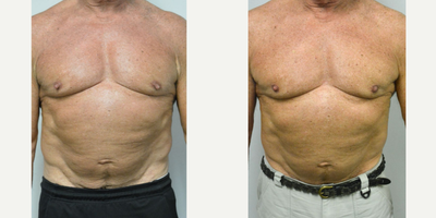 65-74 year old man treated with Nipple  Reduction Surgery - An athletic man in his early 70s who had been troubled for years by prominent nipples that showed through his shirts. He did not want an extremely flat nipple papule as is the request of some men, but wanted to have normal prominence of the nipple papule with his shirt off, but correction of the excessive prominence. He is shown before and again, 3 months after nipple papule reduction in the office.